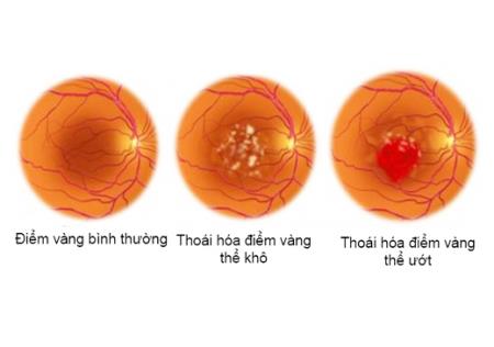 Khám mắt định kỳ để phòng ngừa bệnh thoái hóa điểm vàng - Sức Khỏe Quảng  NinhSức Khỏe Quảng Ninh
