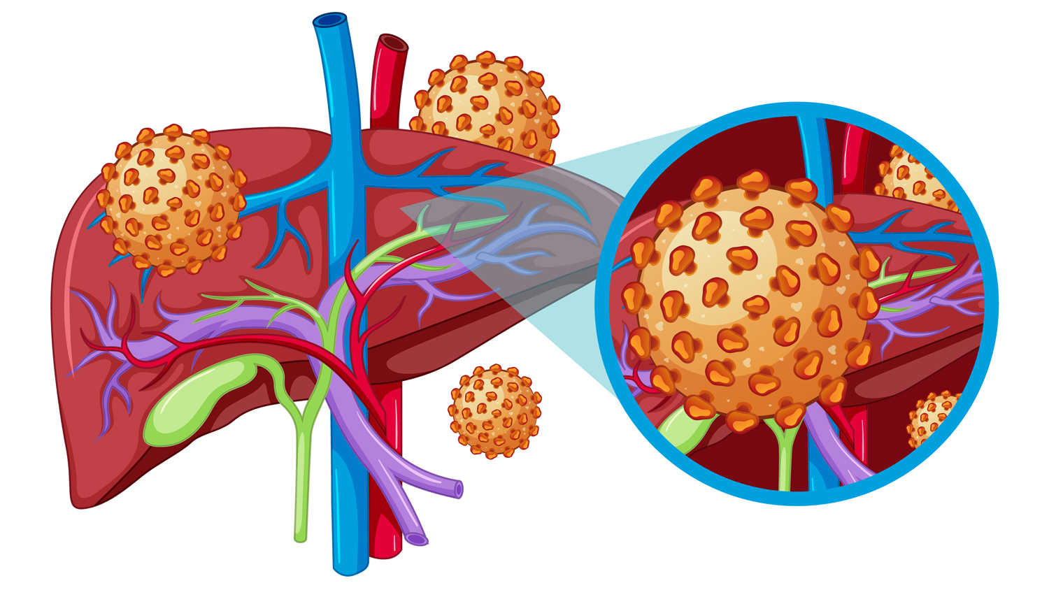 Medical Education: Human Anatomy of Liver with Hepatitis