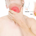 Ung thư tuyến giáp – Căn bệnh âm thầm nhưng có thể chữa khỏi nếu phát hiện sớm