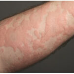 Quảng Ninh: Gia tăng số lượng người mắc mẩn ngứa, mề đay – cảnh báo từ bác sĩ chuyên khoa