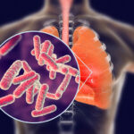 Những điều cần biết về bệnh Lao đồng nhiễm HIV