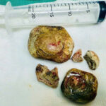 Phẫu thuật thành công lấy khối sỏi bàng quang lớn cho người bệnh