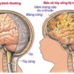 (Phát thanh) Cẩn trọng với viêm màng não ở trẻ