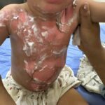 Cảnh báo tai nạn bỏng nước sôi ở trẻ nhỏ