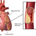 Trẻ hóa nhồi máu cơ tim – Hồi chuông cảnh báo từ những ca bệnh nguy kịch