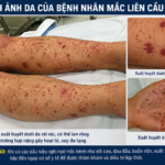 Chủ động phòng, chống bệnh liên cầu lợn – Bảo vệ sức khỏe bản thân, gia đình và cộng đồng