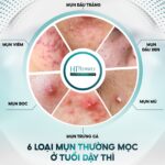 Mụn tuổi dậy thì: Đừng để những nốt mụn lấy đi sự tự tin của con