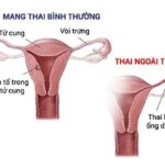(Phát thanh) Không chủ quan với mang thai ngoài tử cung
